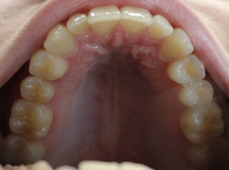 after invisalign treatment results
