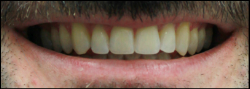 results Invisalign