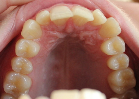 Invisalign