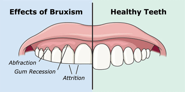 night splints and snore guards