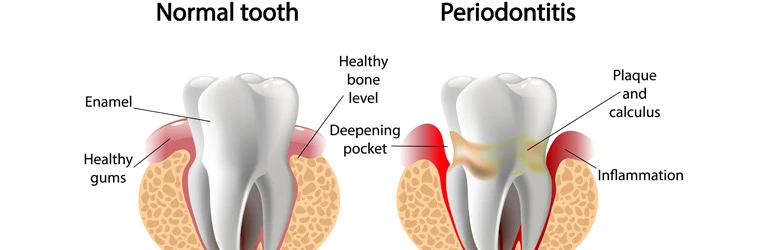 Diagram of teeth with periodontitis